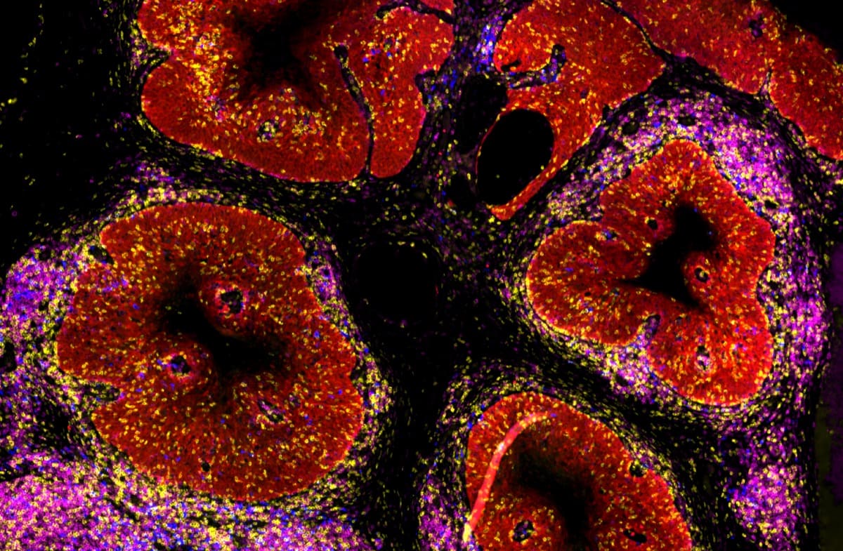 Understanding CIN2 Through Spatial Single-Cell Imaging: A Doctoral Researcher’s Perspective